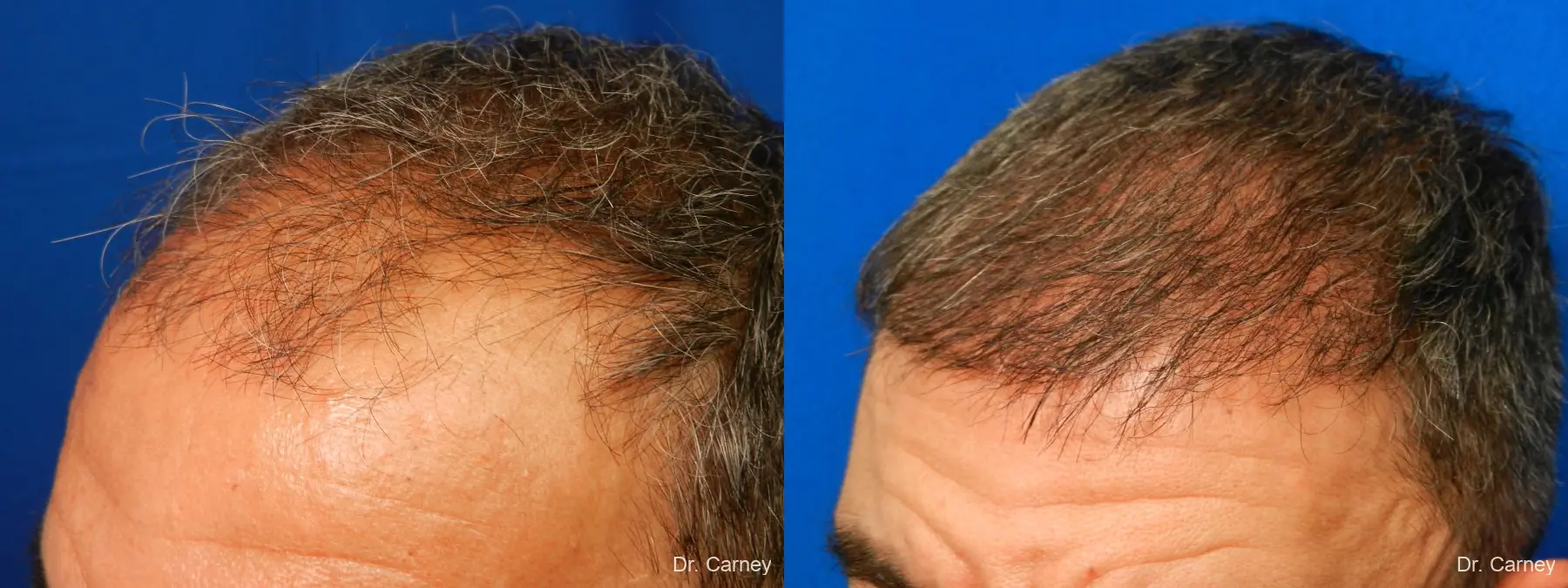 Hair Transplantation: Patient 17 - Before and After 3
