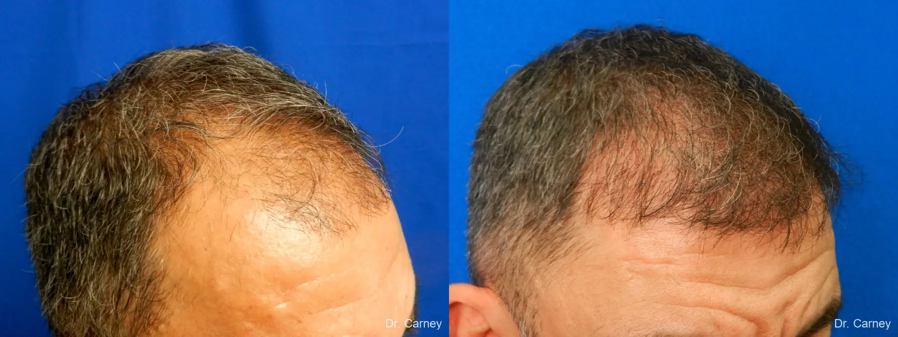 Hair Transplantation: Patient 17 - Before and After 2