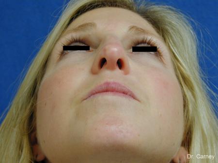 Virginia Beach Rhinoplasty 1343 - Before Image 2