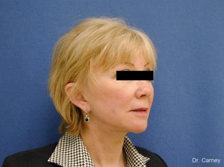Virginia Beach Facelift 1262 - After Image 2