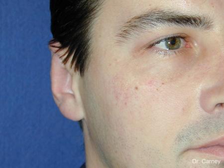 Virginia Beach Otoplasty Earlobe Repair 1237 - After Image 4