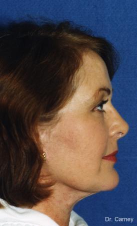Virginia Beach Facelift 1137 - After Image 3