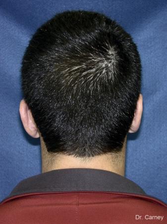 Virginia Beach Otoplasty Earlobe Repair 1222 - After Image 5