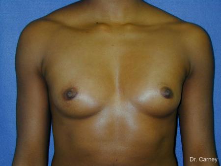 Virginia Beach Breast Augmentation 1085 - Before and After Image 3