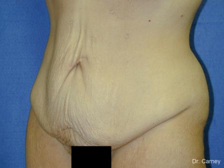 Virginia Beach Tummy Tuck 1249 - Before Image 1