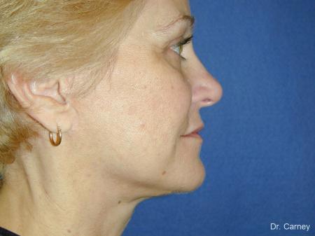 Virginia Beach Facelift 1346 - After Image 5