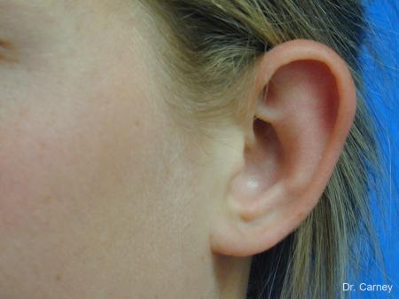 Virginia Beach Otoplasty Earlobe Repair 1223 - Before Image 1