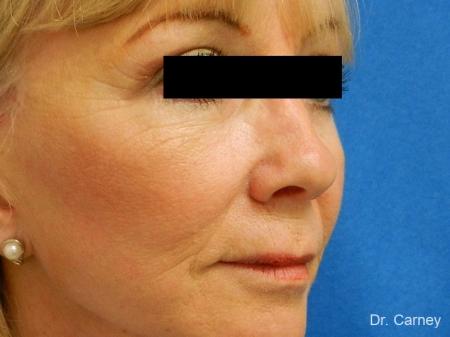 Virginia Beach Brow Lift 1266 - After Image 1