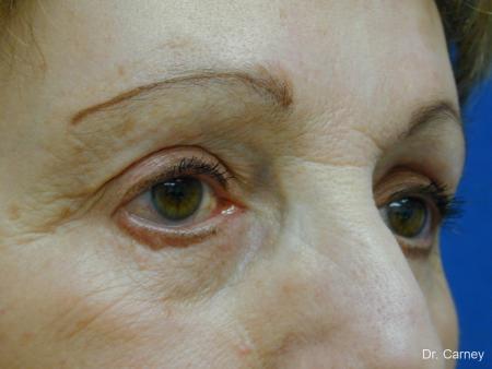 Virginia Beach Facelift 1133 - Before and After Image 3
