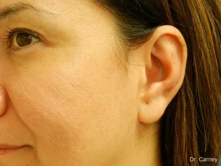 Virginia Beach Otoplasty Earlobe Repair 1225 - After Image 4