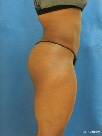 Brazilian Butt Lift: Patient 3 - After Image 1