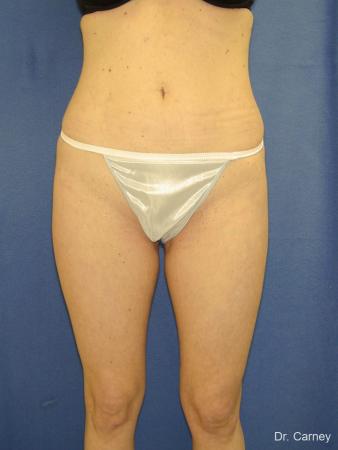Virginia Beach Liposuction 1280 - After Image 1
