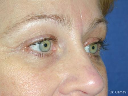 Virginia Beach Brow Lift 1345 - After Image 4