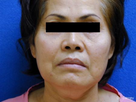 Virginia Beach Neck Lift 1268 - Before Image 1
