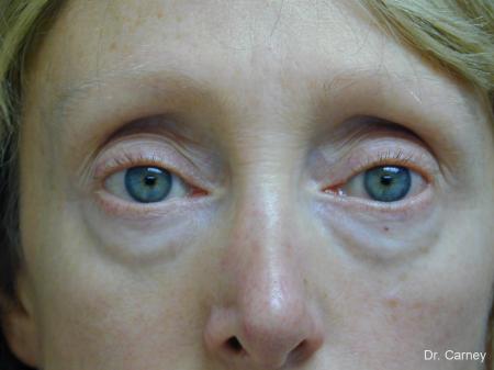 Virginia Beach Eyelid Lift 1079 - Before Image 1