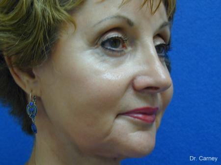 Virginia Beach Brow Lift 1216 - After Image 1