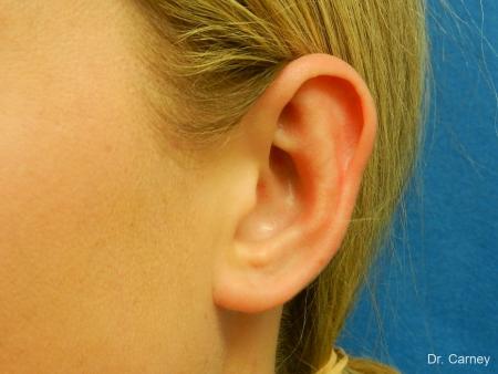 Virginia Beach Otoplasty Earlobe Repair 1223 - After Image 1
