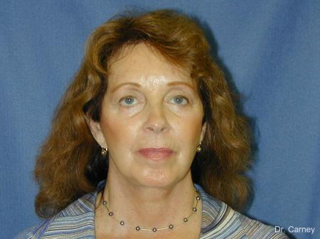 Virginia Beach Facelift 1127 - After Image 3