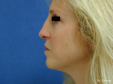 Virginia Beach Rhinoplasty 1343 - Before and After Image 5