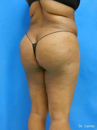 Brazilian Butt Lift: Patient 4 - After Image 4