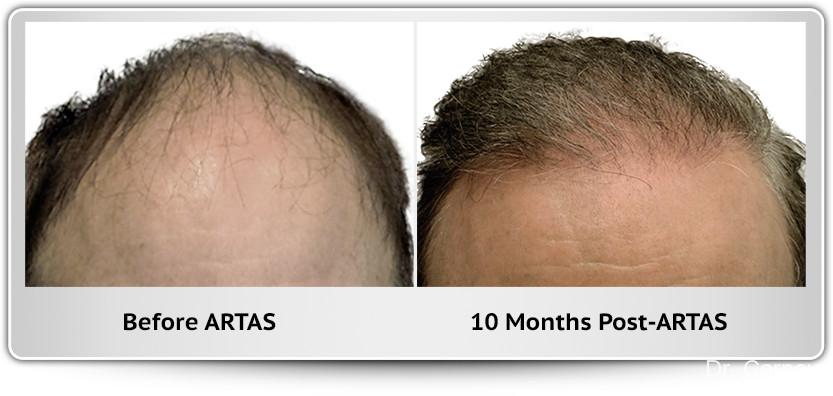 Hair Transplantation: Patient 14 - Before and After 