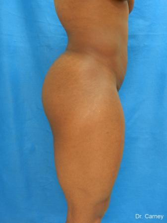 Brazilian Butt Lift: Patient 3 - Before Image 1