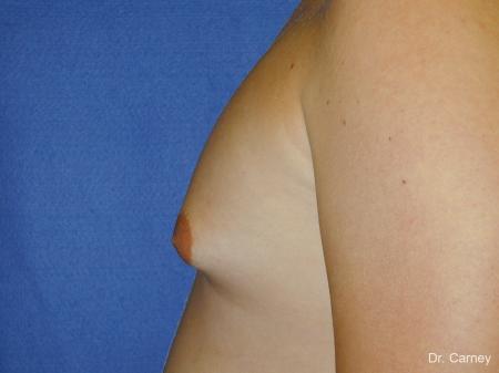 Virginia Beach Gynecomastia - Before and After Image 4