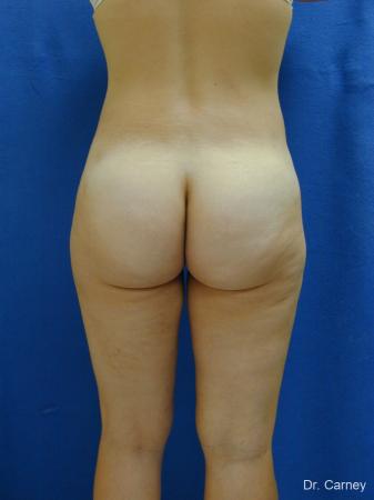 Virginia Beach Liposuction 1285 - After Image 5