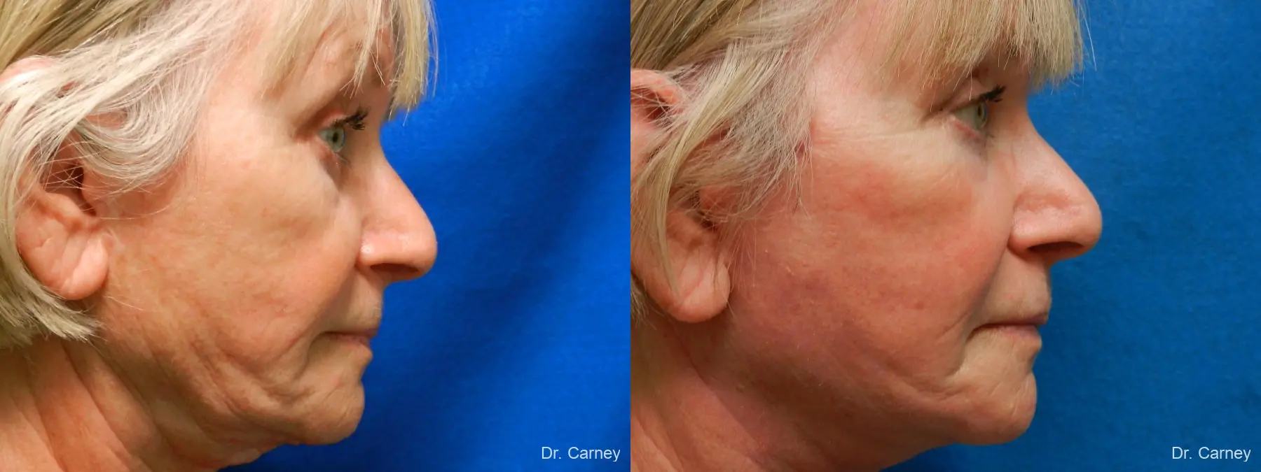 Laser Skin Resurfacing - Face: Patient 5 - Before and After 3