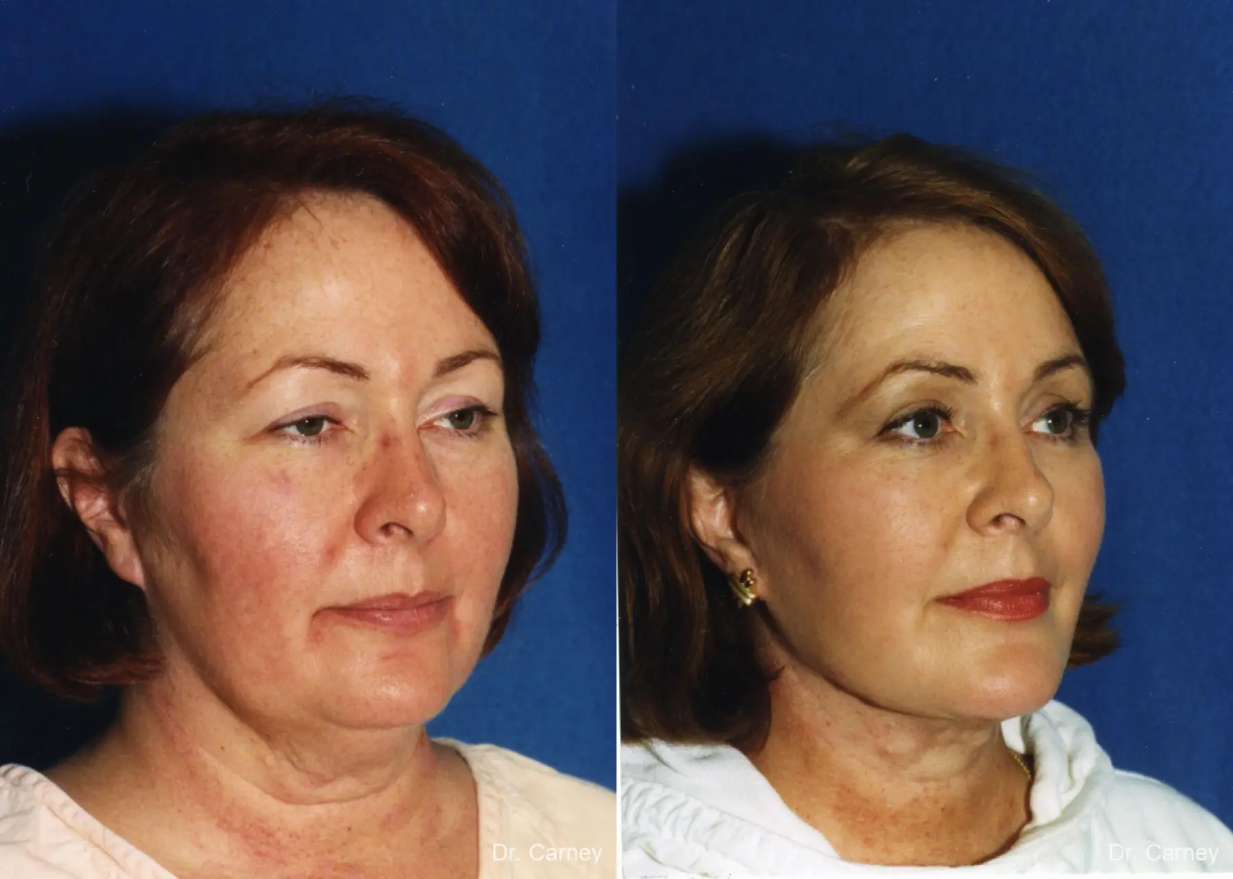 Virginia Beach Laser Skin Resurfacing - Face - Before and After 1