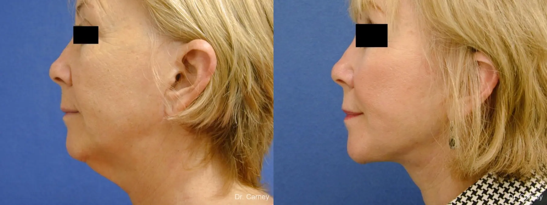 Virginia Beach Laser Skin Resurfacing Face 1263 - Before and After 4