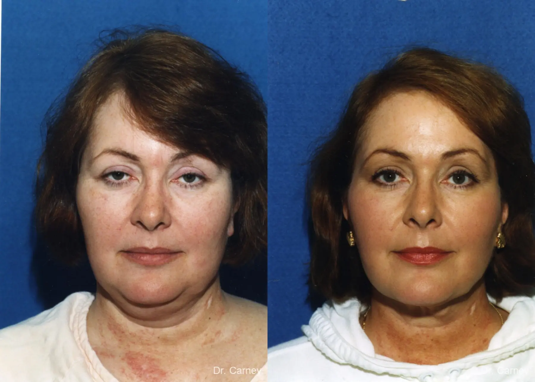 Virginia Beach Laser Skin Resurfacing - Face - Before and After 2
