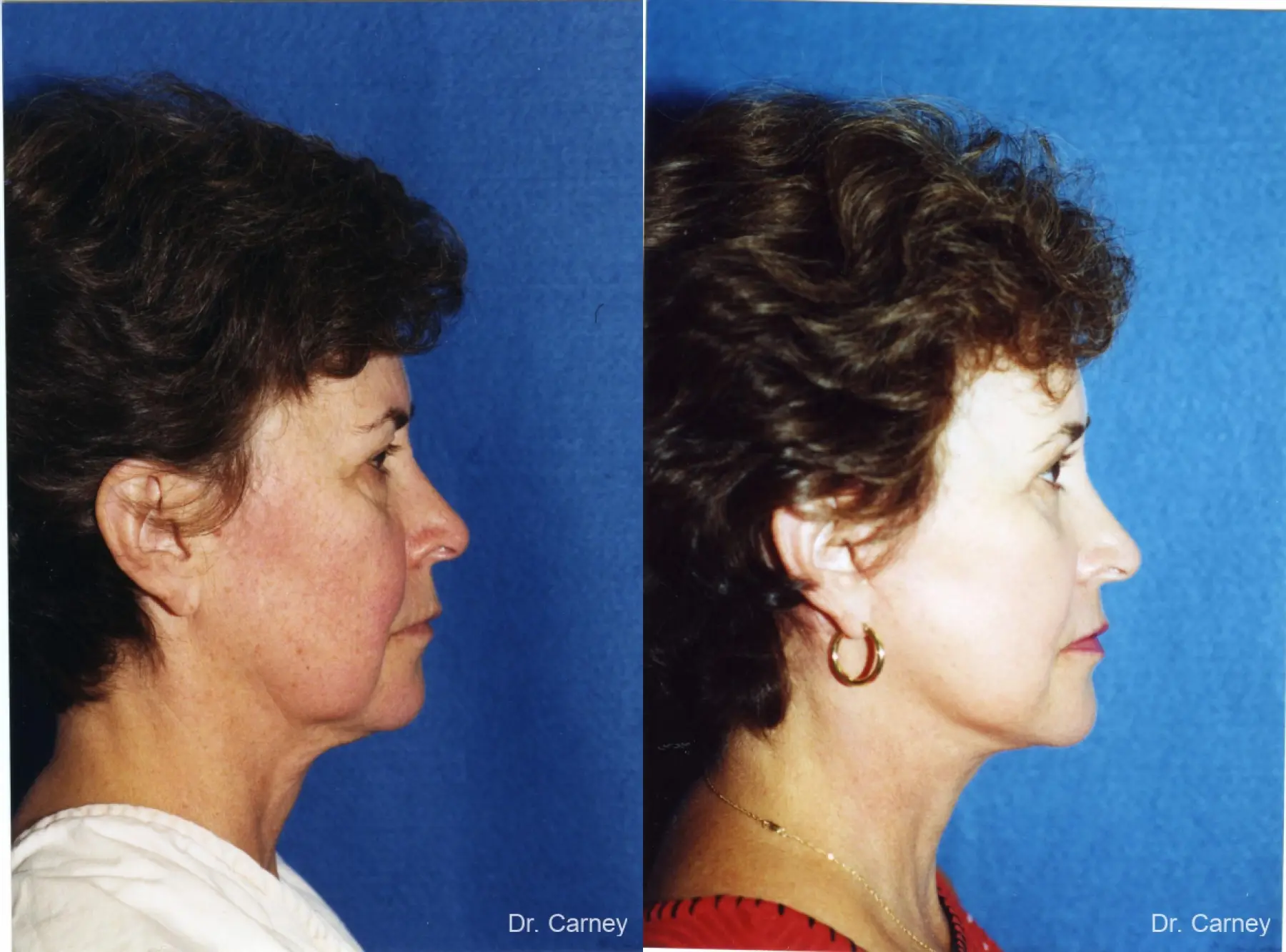 Virginia Beach Laser Skin Resurfacing - Face 1259 - Before and After 2