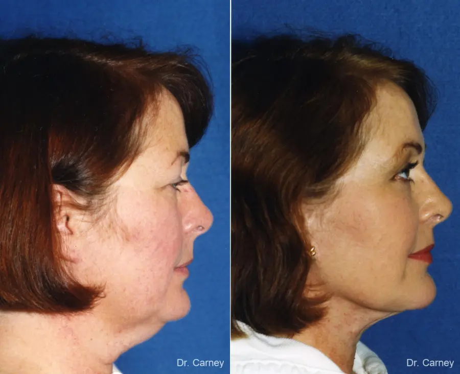 Virginia Beach Laser Skin Resurfacing - Face - Before and After 3