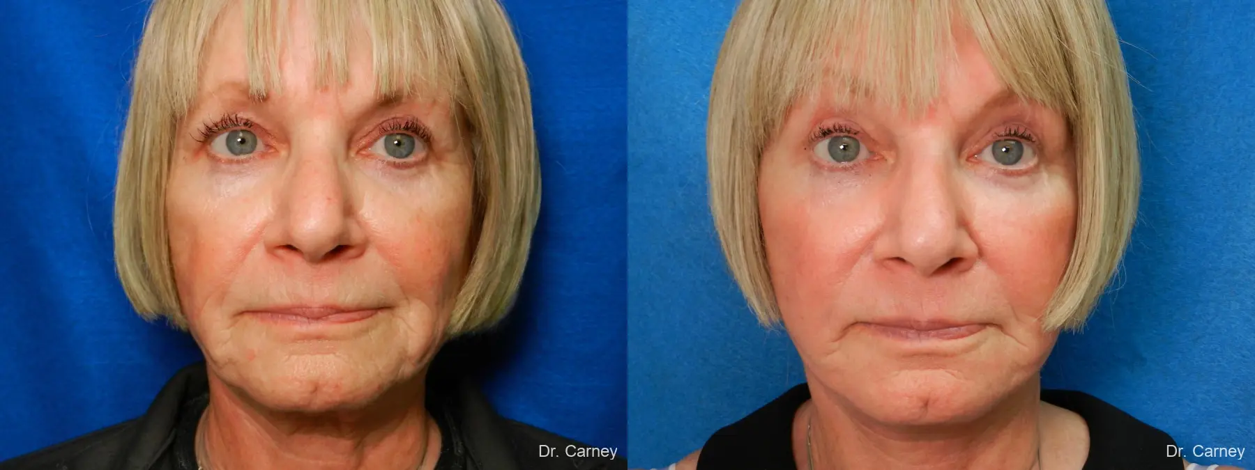 Laser Skin Resurfacing - Face: Patient 5 - Before and After 1