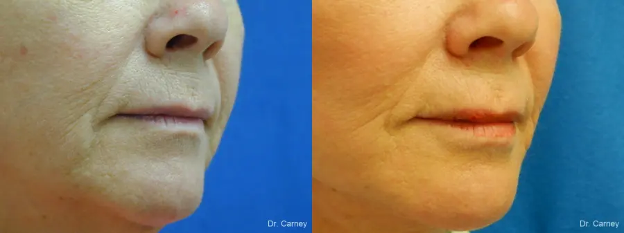 Virginia Beach Laser Skin Resurfacing Face 1263 - Before and After 3