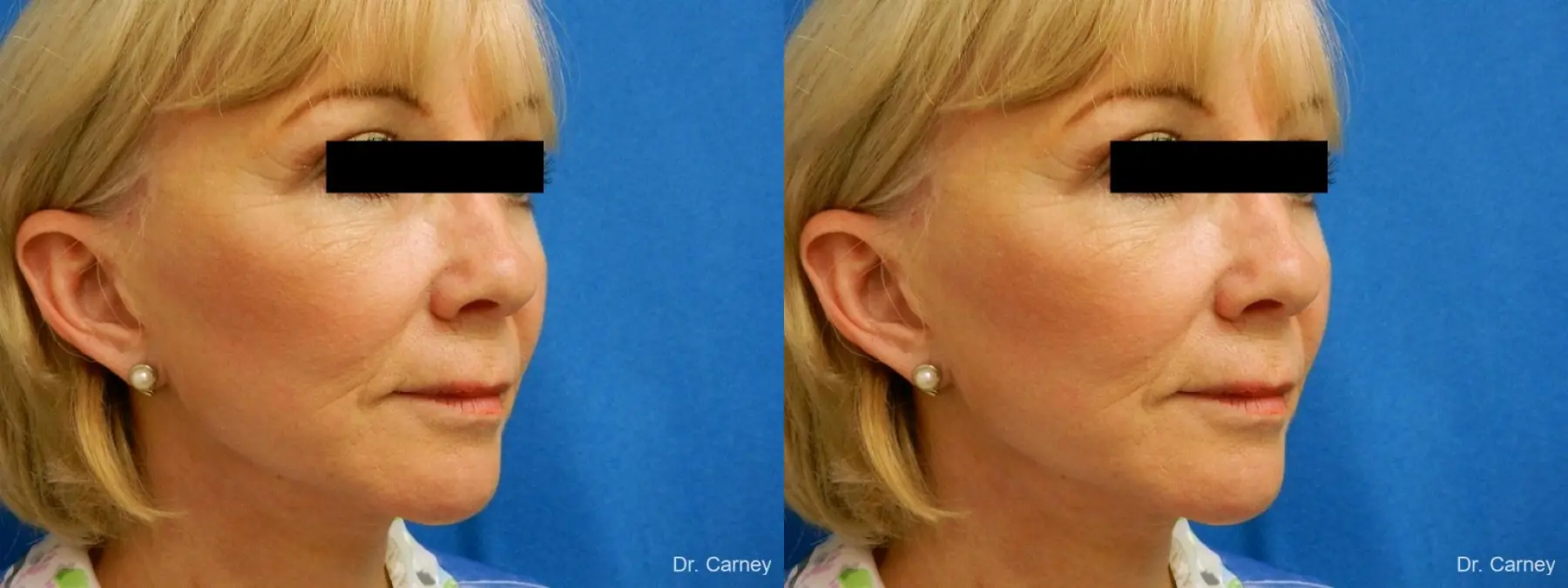 Virginia Beach Laser Skin Resurfacing Face 1263 - Before and After 2
