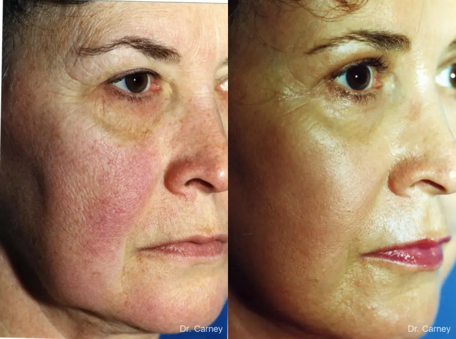 Virginia Beach Laser Skin Resurfacing - Face 1259 - Before and After 3