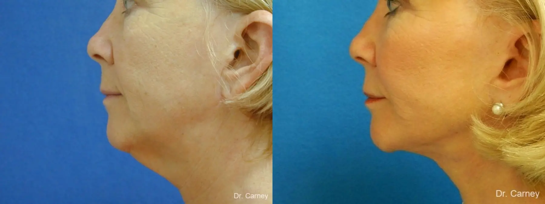 Virginia Beach Laser Skin Resurfacing - Face 1260 - Before and After 3