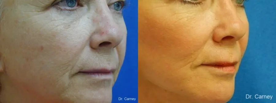 Virginia Beach Laser Skin Resurfacing - Face 1260 - Before and After 1