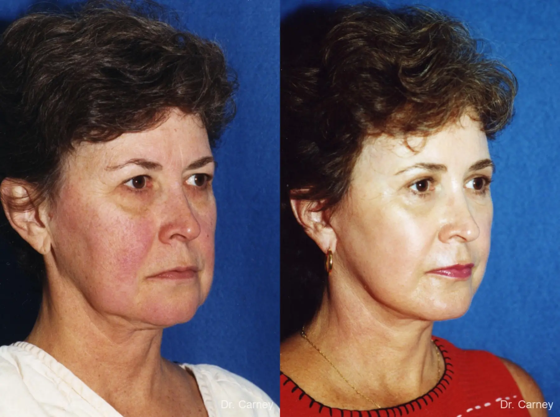 Virginia Beach Laser Skin Resurfacing - Face 1259 - Before and After