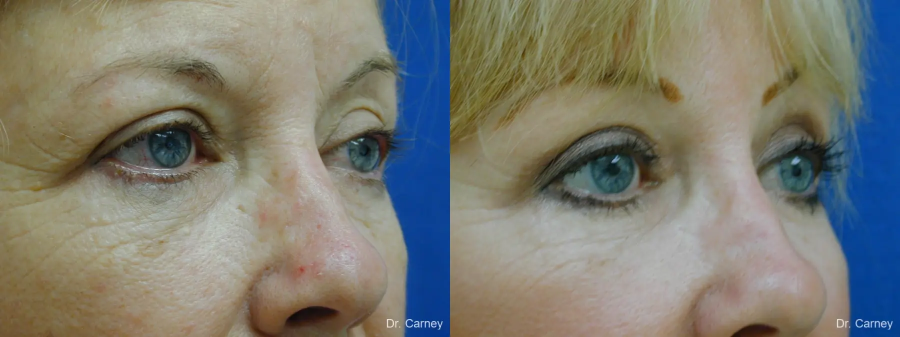 Virginia Beach Laser Skin Resurfacing Face 1263 - Before and After 1