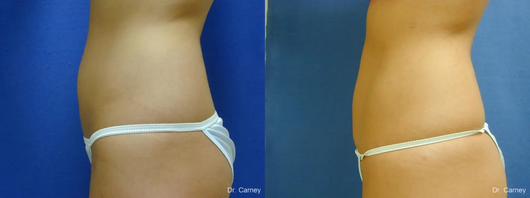 Virginia Beach Liposuction 1277 - Before and After 5