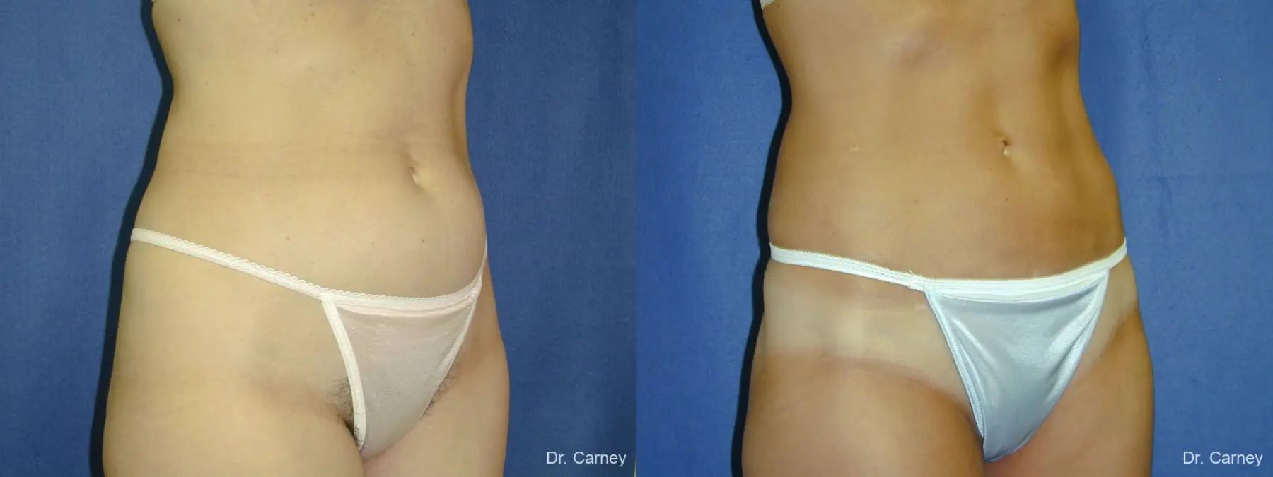 Virginia Beach Liposuction 1282 - Before and After 2