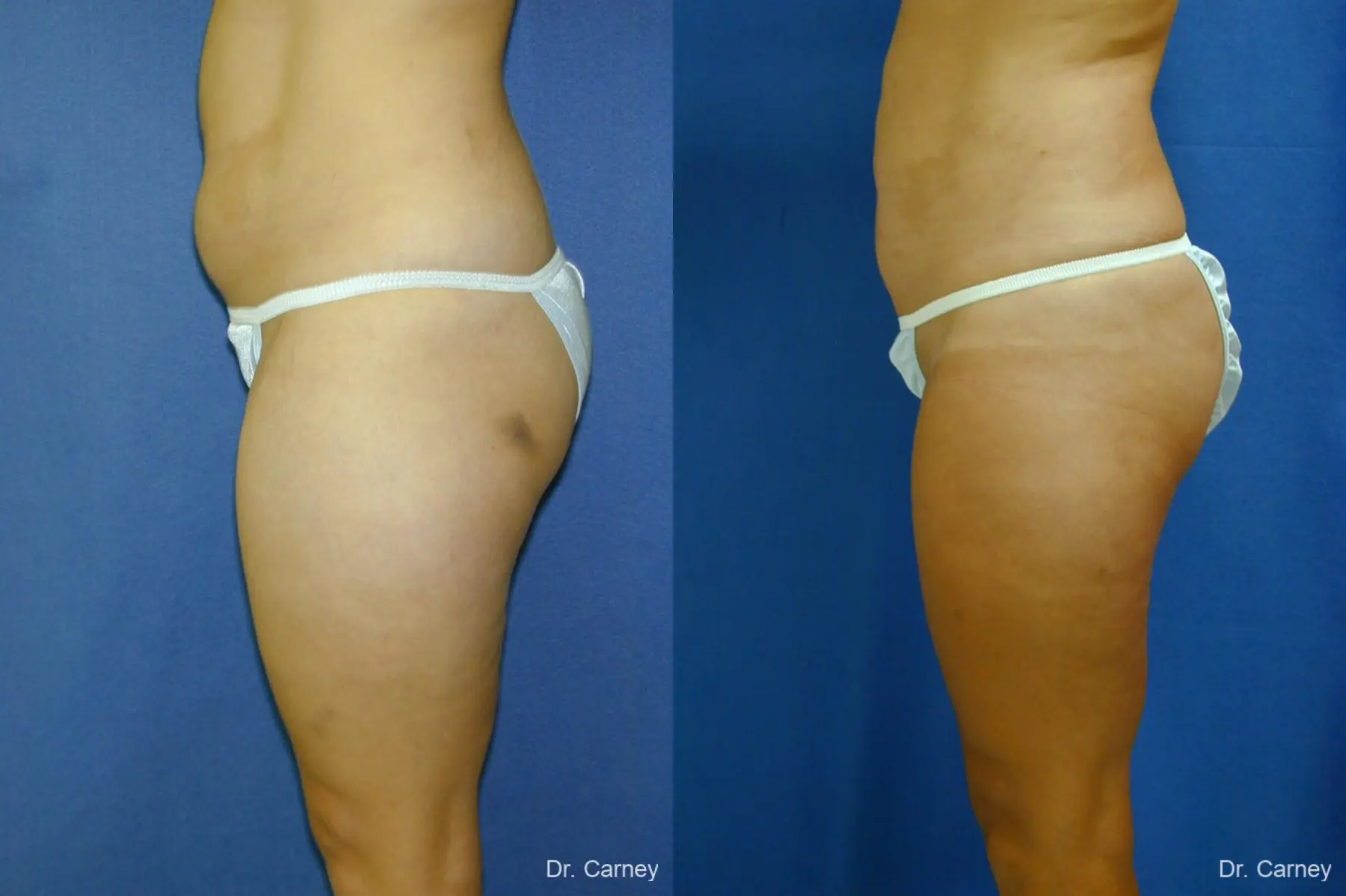 Virginia Beach Liposuction 1284 - Before and After 3