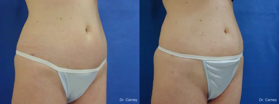 Virginia Beach Liposuction 1280 - Before and After 4