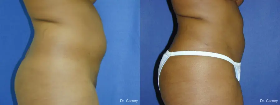 Virginia Beach Liposuction 1283 - Before and After 2