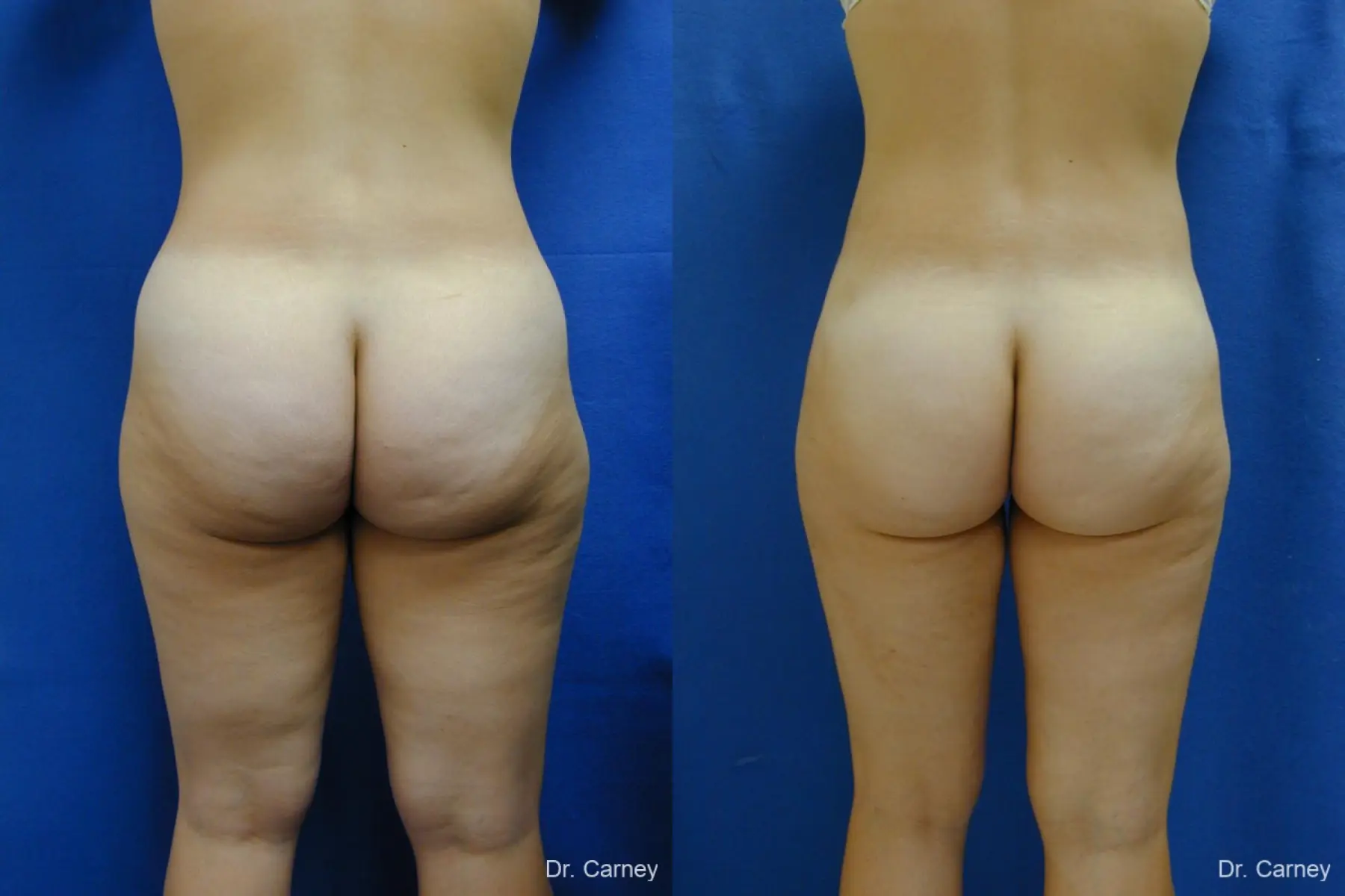Virginia Beach Liposuction 1276 - Before and After 3