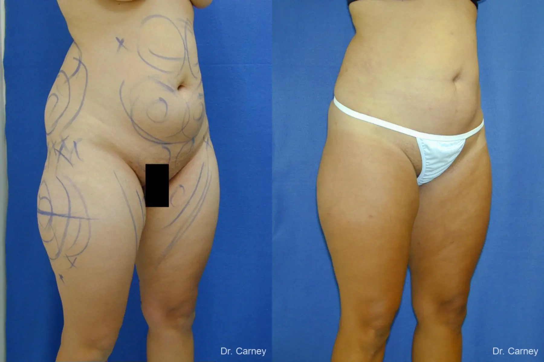 Virginia Beach Liposuction 1284 - Before and After 5