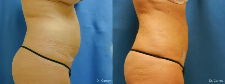 Virginia Beach Liposuction 1279 - Before and After 2